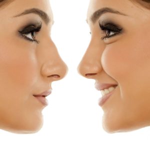 Rhinoplastie médicale