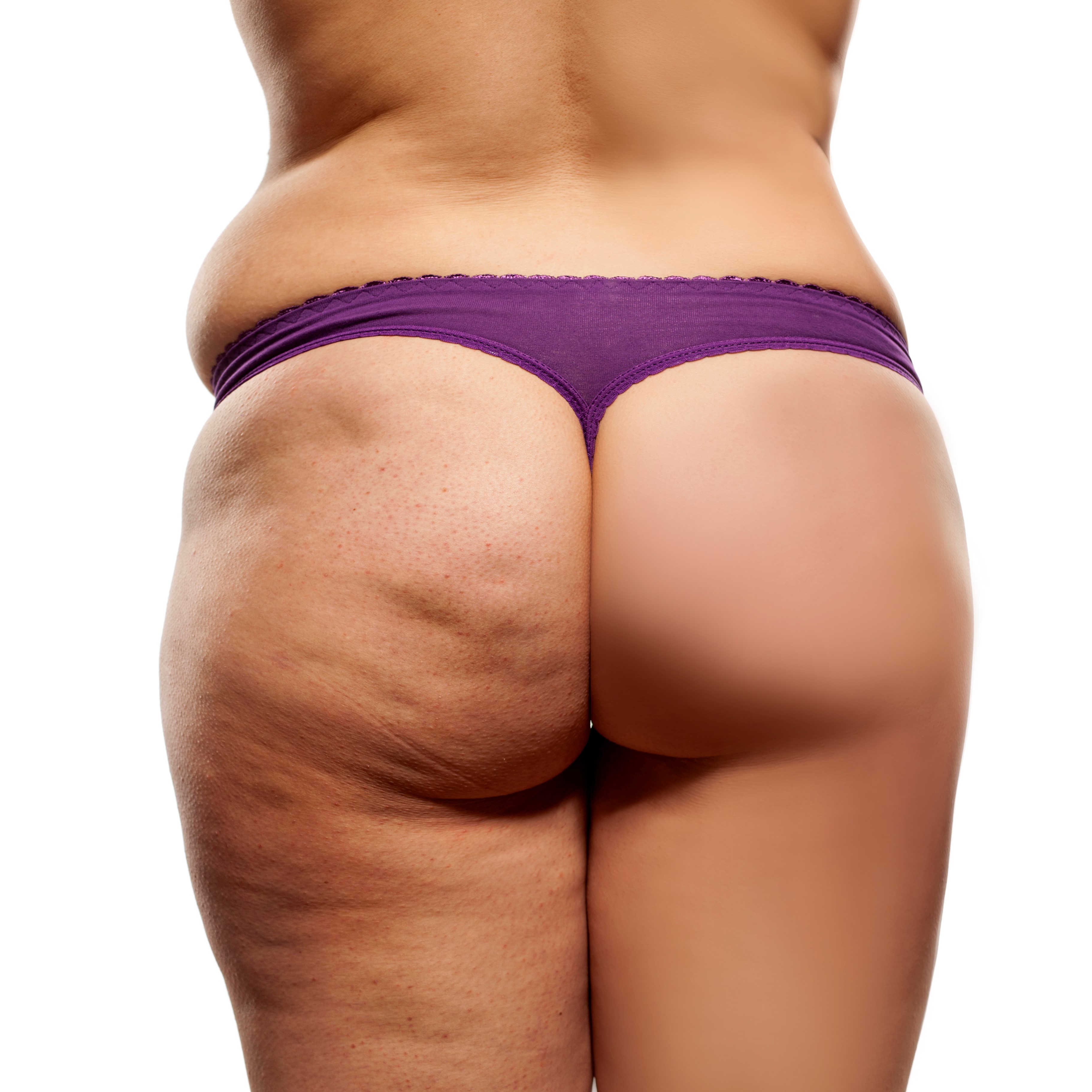Cellulite