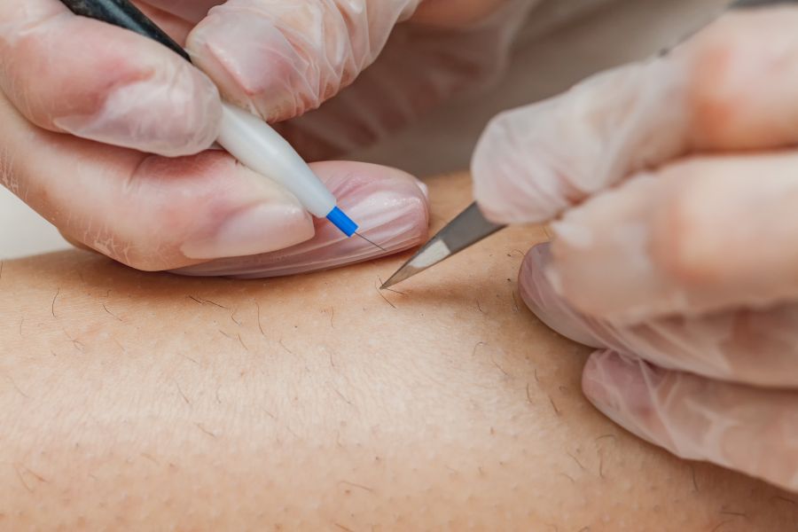 Epilation électrolyse